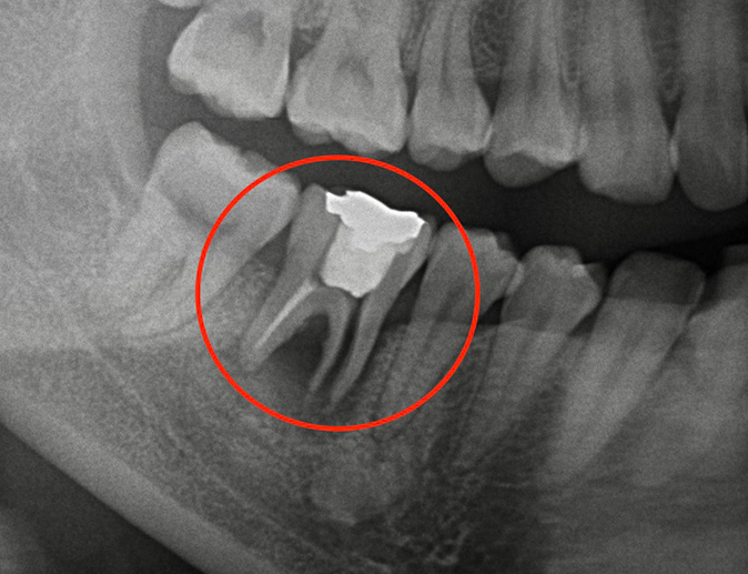 【歯根破折の症例写真】