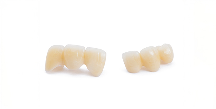 ブリッジ治療がおすすめな方