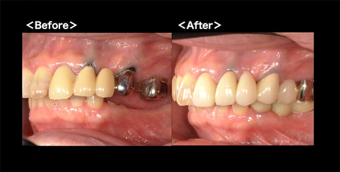 【症例】①保険診療で、できる限り白いブリッジに