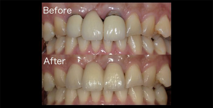 【症例】②ジルコニアセラミックによる前歯のブリッジ