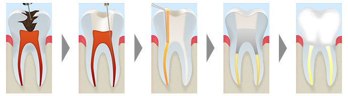 根管治療は、ご自身の歯をできる限り残すために行う治療です
