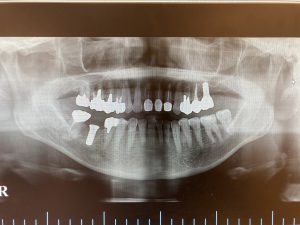 左上奥歯の根管治療及びインプラント治療の症例 ジルコニアでできた上部構造（被せ物）をセット後のレントゲン画像 ｜港南台の歯医者｜港南台パーク歯科クリニック