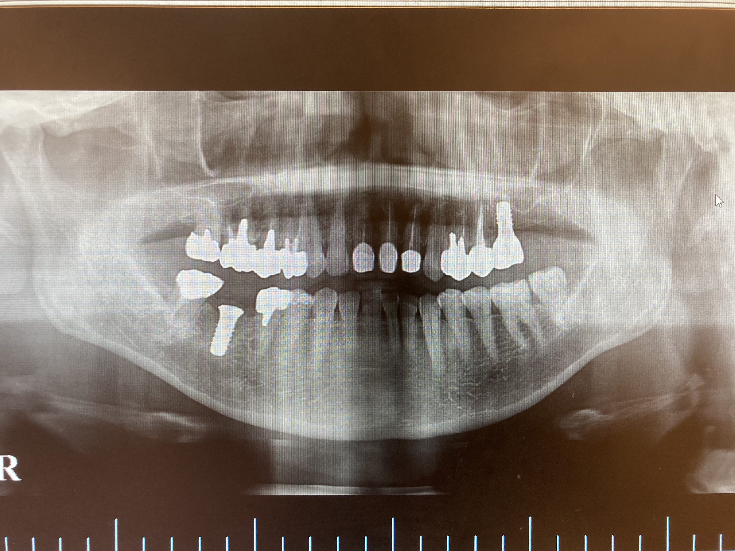 症例 左上奥歯の根管治療及びインプラント治療 港南台パーク歯科クリニック
