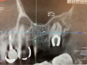 左上奥歯の根管治療及びインプラント治療の症例 左上５番の根の治療をしっかり行い、治癒を確認した後にインプラント治療を行うCT画像 ｜港南台の歯医者｜港南台パーク歯科クリニック