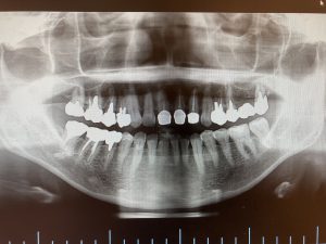 左上奥歯の根管治療及びインプラント治療の症例 左上７番目の歯の根が膿んでいることが疑われレントゲン画像 ｜港南台の歯医者｜港南台パーク歯科クリニック