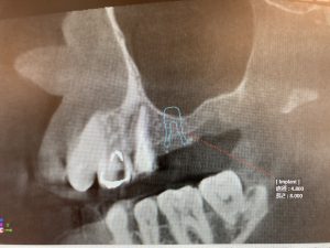 左上奥歯の根管治療及びインプラント治療の症例 左上５番の根の治療後、治癒を確認できるCT画像 ｜港南台の歯医者｜港南台パーク歯科クリニック