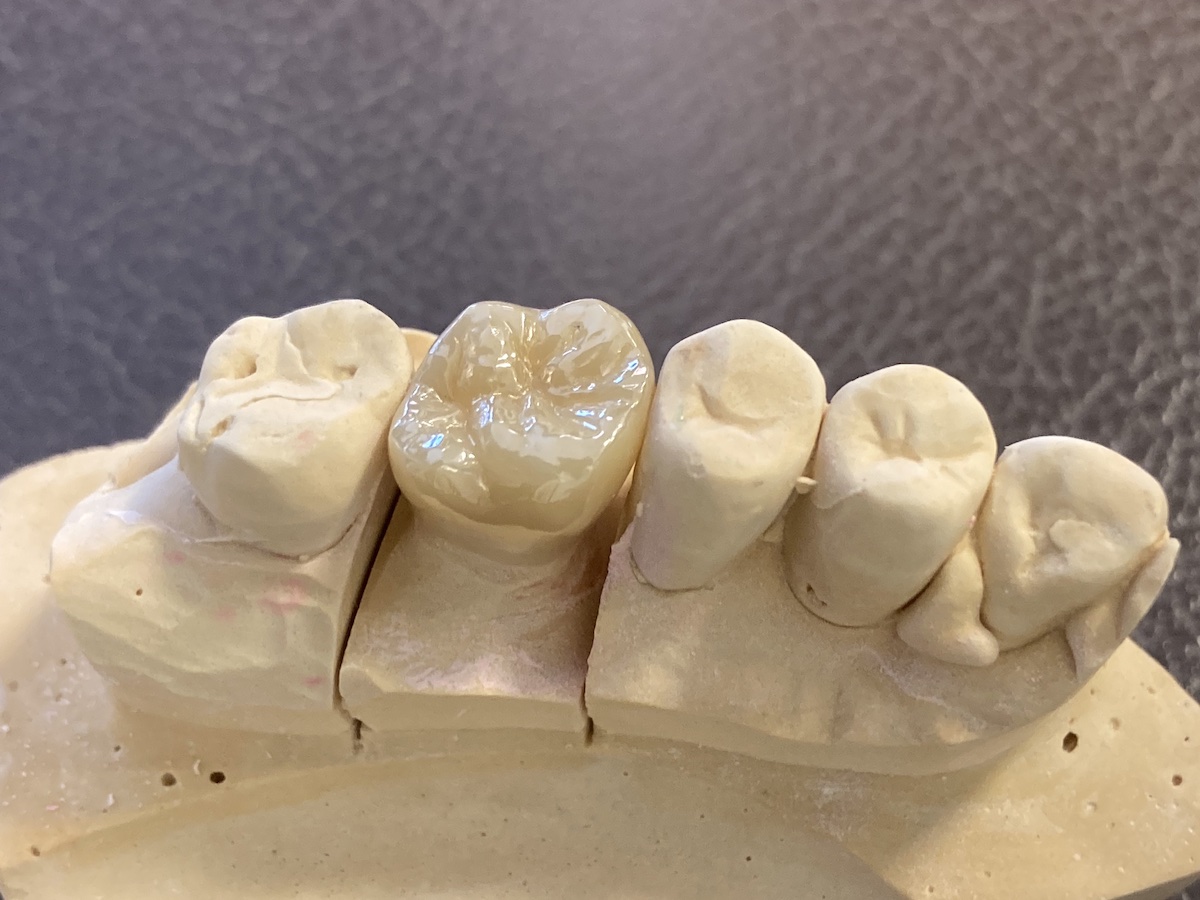 症例】右上奥歯のジルコニア修復（一般的なむし歯治療の流れ）｜港南台
