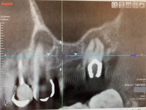 左上奥歯の根管治療及びインプラント治療の症例 左上５番と７番の根の先に大きな病巣を認めるCT画像 ｜港南台の歯医者｜港南台パーク歯科クリニック