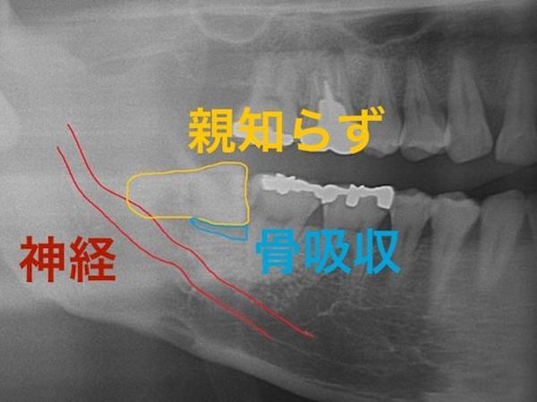 港南台の歯医者｜港南台パーク歯科クリニック｜【症例】右下親知らず抜歯の治療｜治療前の歯のレントゲン画像1