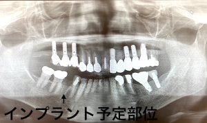 港南台の歯医者｜港南台パーク歯科クリニック｜【症例】他院から依頼されたインプラント治療｜治療前の歯の画像1