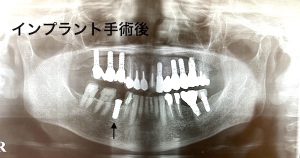 港南台の歯医者｜港南台パーク歯科クリニック｜【症例】他院から依頼されたインプラント治療｜インプラント治療後の歯の画像6