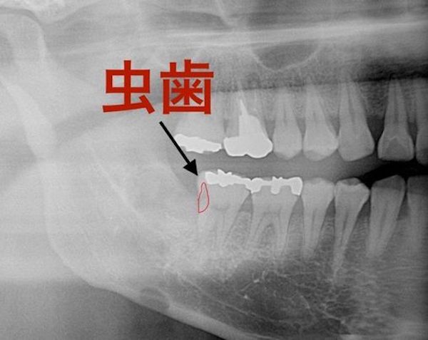 港南台の歯医者｜港南台パーク歯科クリニック｜【症例】右下親知らず抜歯の治療｜虫歯が確認できるレントゲン画像5