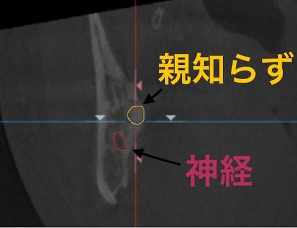 港南台の歯医者｜港南台パーク歯科クリニック｜【症例】右下親知らず抜歯の治療｜治療前に歯科用CTで撮影した画像2