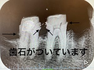 港南台の歯医者｜港南台パーク歯科クリニック｜【症例】他院から依頼されたインプラント治療｜SRP後の歯の画像3