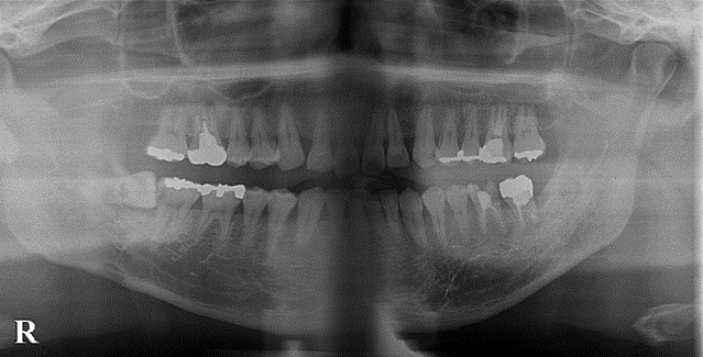 港南台の歯医者｜港南台パーク歯科クリニック｜【症例】右下親知らず抜歯の治療｜治療前の歯のレントゲン画像1