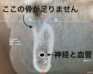 港南台の歯医者｜港南台パーク歯科クリニック｜【症例】他院から依頼されたインプラント治療｜歯科用CTで撮影した歯の画像4