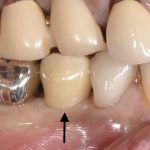 港南台の歯医者｜港南台パーク歯科クリニック｜【症例】他院から依頼されたインプラント治療｜治療後の経過観察時の歯の画像12