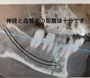 港南台の歯医者｜港南台パーク歯科クリニック｜【症例】他院から依頼されたインプラント治療｜歯科用CTで撮影した歯の画像5