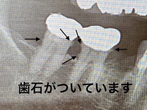 港南台の歯医者｜港南台パーク歯科クリニック｜【症例】他院から依頼されたインプラント治療｜治療前の歯の画像2