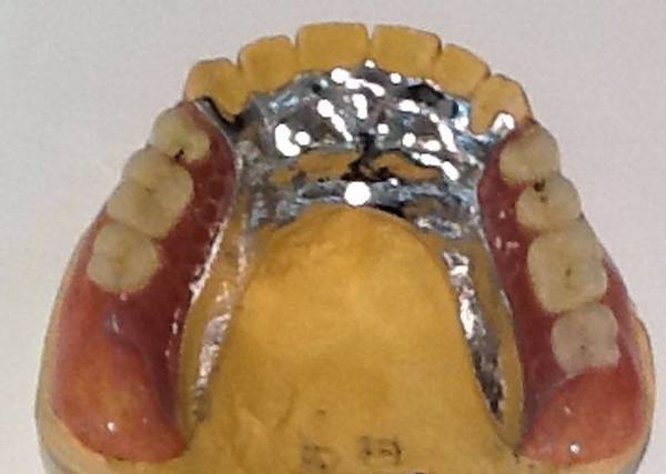 港南台パーク歯科クリニック｜院長ブログ｜【症例】見た目の良い入れ歯｜治療詳細の歯の画像2
