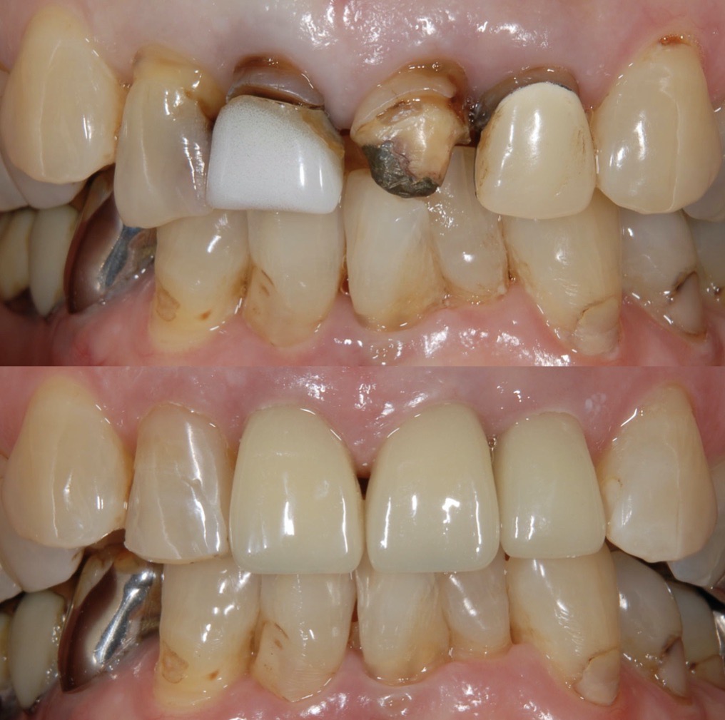 港南台の歯医者｜港南台パーク歯科クリニック｜【症例】セラミッククラウン（e.max）による審美治療｜治療前・治療後の比較写真