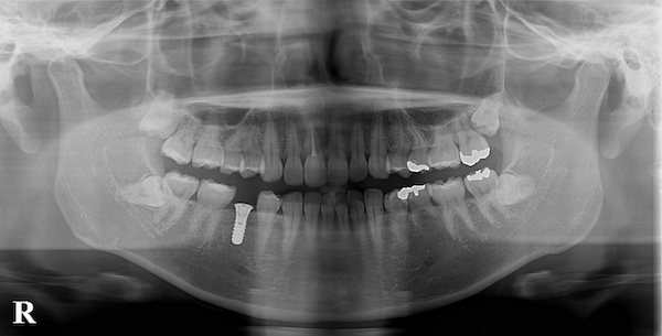 港南台パーク歯科クリニック｜ブログ｜【症例】先天性欠如歯に対するインプラント治療・ジルコニア修復｜インプラント埋入後のレントゲン画像_2