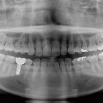 港南台パーク歯科クリニック｜ブログ｜【症例】先天性欠如歯に対するインプラント治療・ジルコニア修復｜ジルコニアを被せた後のレントゲン画像_3