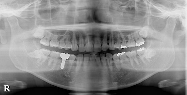 港南台パーク歯科クリニック｜ブログ｜【症例】先天性欠如歯に対するインプラント治療・ジルコニア修復｜ジルコニアを被せた後のレントゲン画像_3