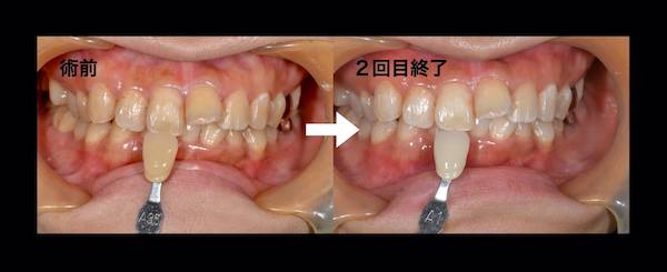 港南台パーク歯科クリニック｜院長ブログ｜【症例】オフィスホワイトニング｜術前と2回目終了時の歯の比較画像