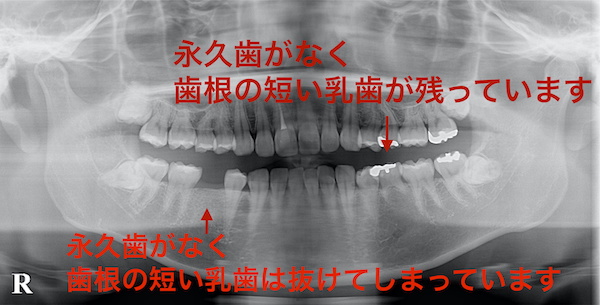 港南台パーク歯科クリニック｜ブログ｜【症例】先天性欠如歯に対するインプラント治療・ジルコニア修復｜治療前のレントゲン画像_1