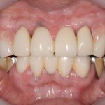 港南台パーク歯科クリニック｜院長ブログ｜【症例】見た目の良い入れ歯｜治療詳細の歯の画像4