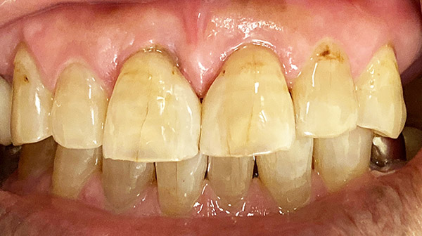 港南台パーク歯科クリニック｜院長ブログ｜【症例】古くなったコンポジットレジン（樹脂の詰め物）の修正｜治療後の歯の画像2