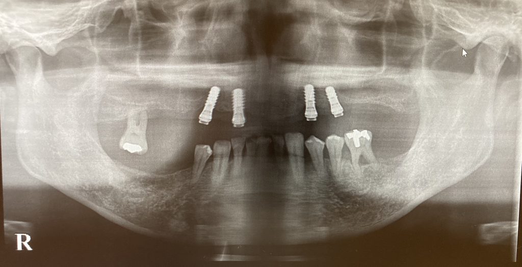 港南台パーク歯科クリニック｜【症例】インプラントを用いた快適な入れ歯｜インプラント治療後のレントゲン写真