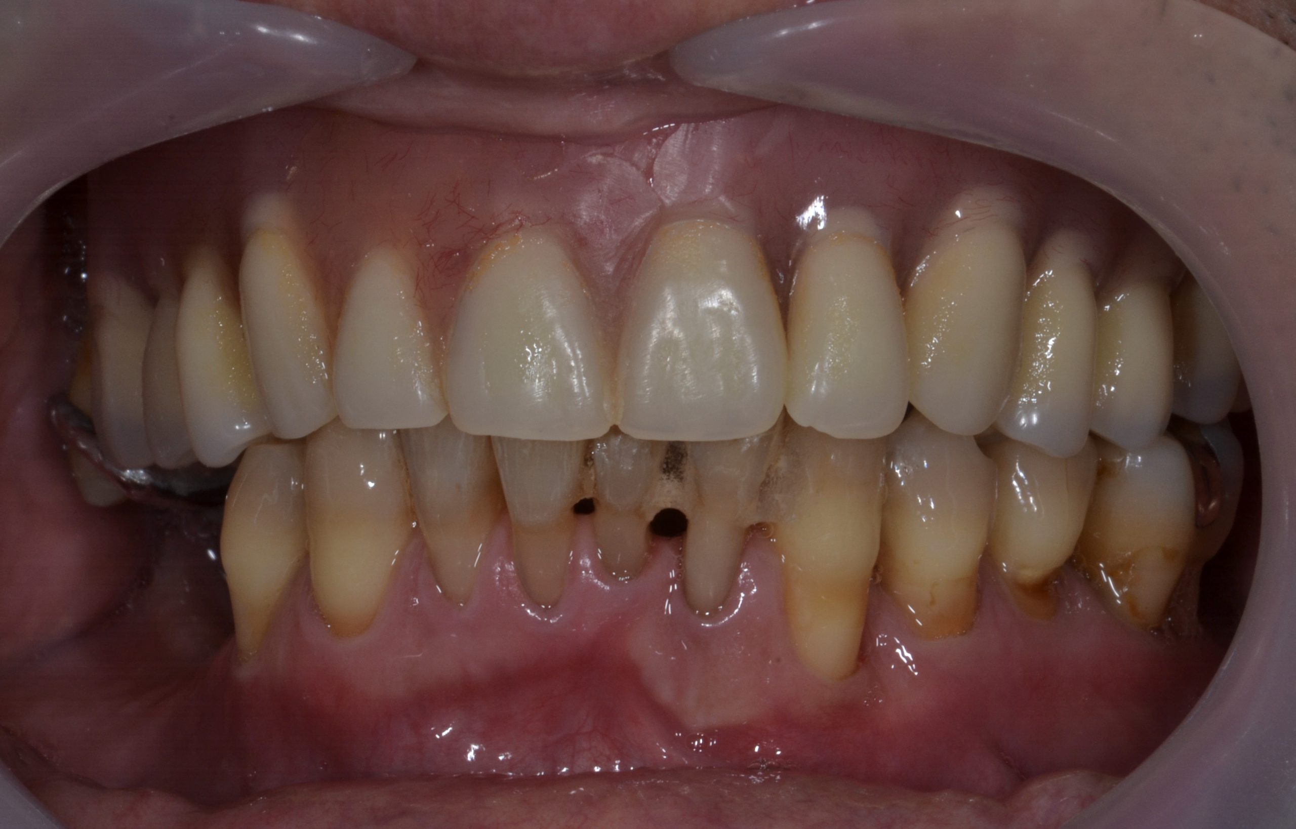 港南台パーク歯科クリニック｜【症例】インプラントを用いた快適な入れ歯｜入れ歯を装着した写真