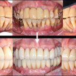 港南台パーク歯科クリニック｜症例｜【症例】歯周病に対するインプラント治療｜治療前後の比較メイン画像-1