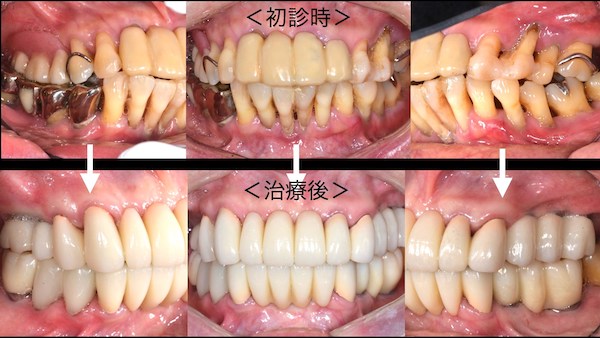 港南台パーク歯科クリニック｜症例｜【症例】歯周病に対するインプラント治療｜治療前後の前歯の比較画像-4