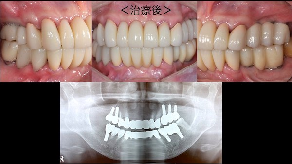 港南台パーク歯科クリニック｜症例｜【症例】歯周病に対するインプラント治療｜治療後の歯の写真とレントゲン画像-3