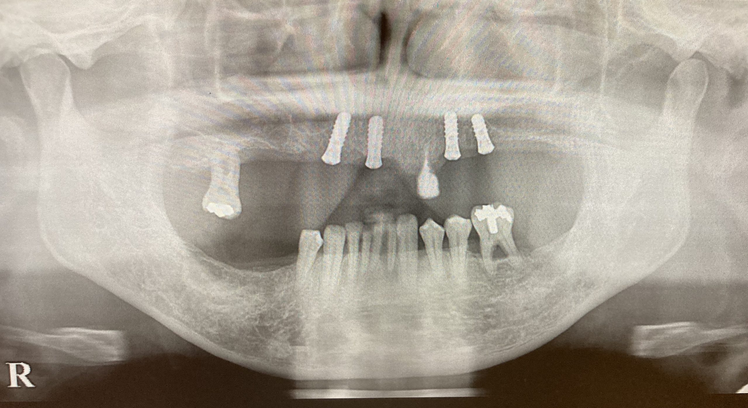 港南台パーク歯科クリニック｜【症例】インプラントを用いた快適な入れ歯｜インプラント埋入後のレントゲン写真