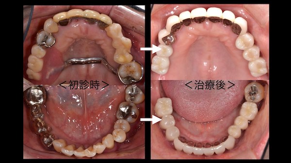 港南台パーク歯科クリニック｜症例｜【症例】歯周病に対するインプラント治療｜治療前後の歯全体の比較画像-5