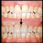 港南台パーク歯科クリニック｜院長ブログ｜症例｜【症例】見た目のよい前歯のブリッジ治療｜治療前後の比較画像1_補正