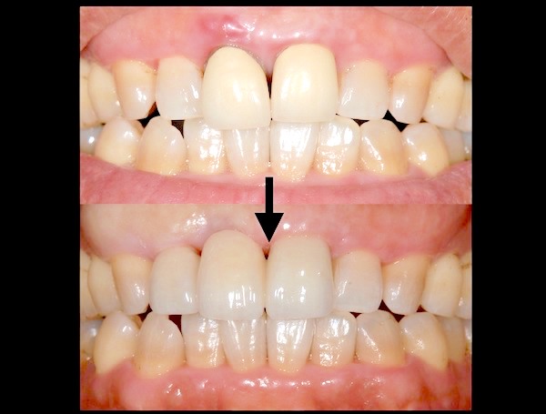 港南台パーク歯科クリニック｜院長ブログ｜症例｜【症例】見た目のよい前歯のブリッジ治療｜治療前後の比較画像1_補正