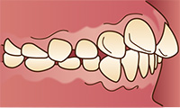 港南台パーク歯科クリニック｜歯科衛生士ブログ｜口腔習癖(こうくうしゅうへき)と歯並び、噛み合わせへの影響｜上顎前突（出っ歯）のイラスト