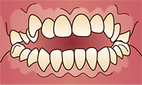 港南台パーク歯科クリニック｜歯科衛生士ブログ｜口腔習癖(こうくうしゅうへき)と歯並び、噛み合わせへの影響｜開咬のイラスト