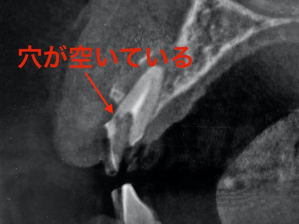 港南台パーク歯科クリニック｜院長ブログ｜症例｜【症例】見た目のよい前歯のブリッジ治療｜歯科用CTで確認した歯の根に穴が開いている画像3