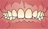 港南台パーク歯科クリニック｜歯科衛生士ブログ｜口腔習癖(こうくうしゅうへき)と歯並び、噛み合わせへの影響｜過蓋咬合のイラスト
