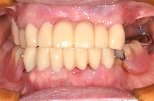 港南台パーク歯科クリニック｜ブログ症例｜歯周病で入れ歯になった患者様の噛み合わせ・見た目の回復｜治療詳細画像4