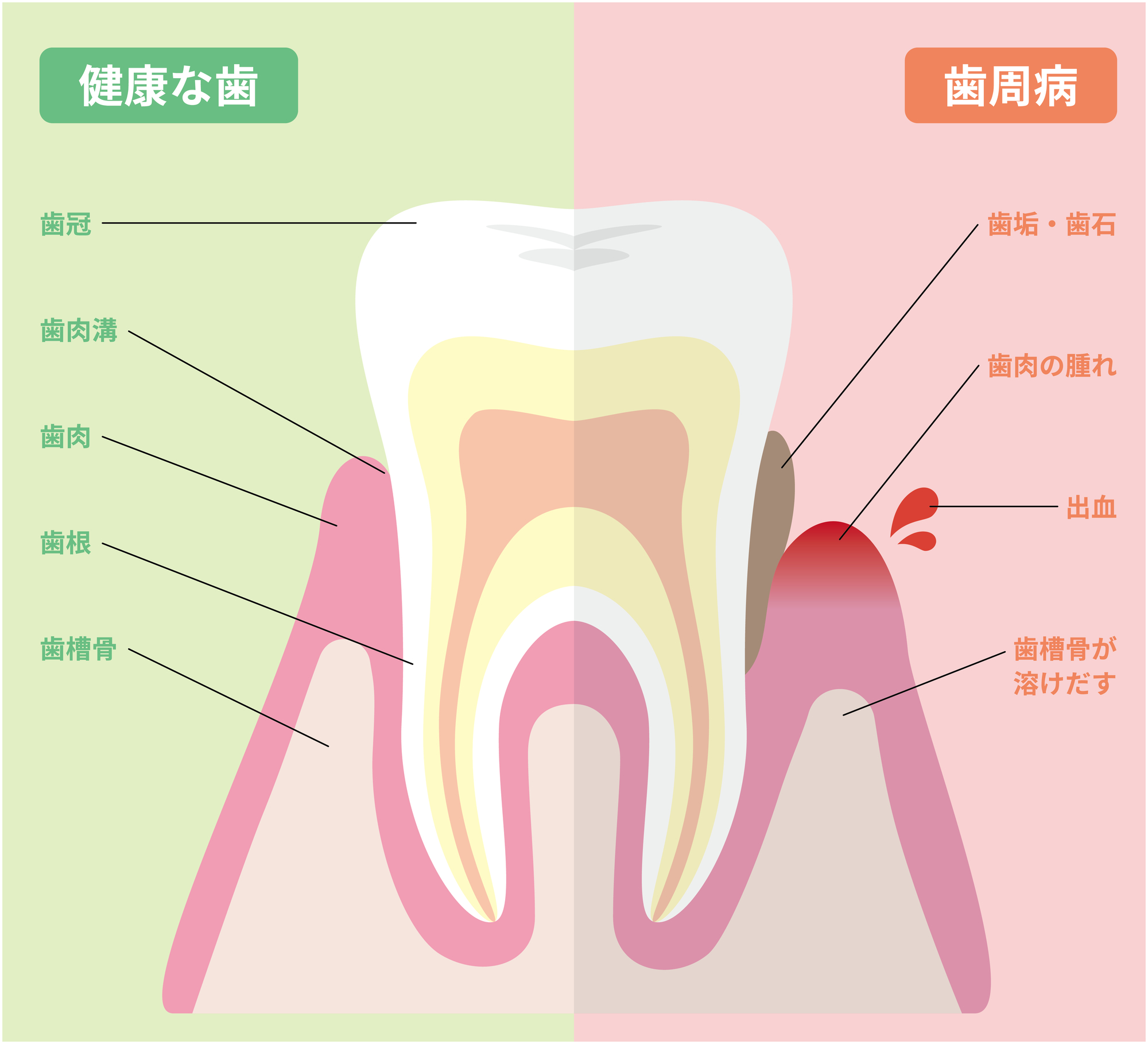 港南台パーク歯科クリニック｜虫歯や歯周病、犬や猫と人間とはどう違うの｜歯周病のメカニズム