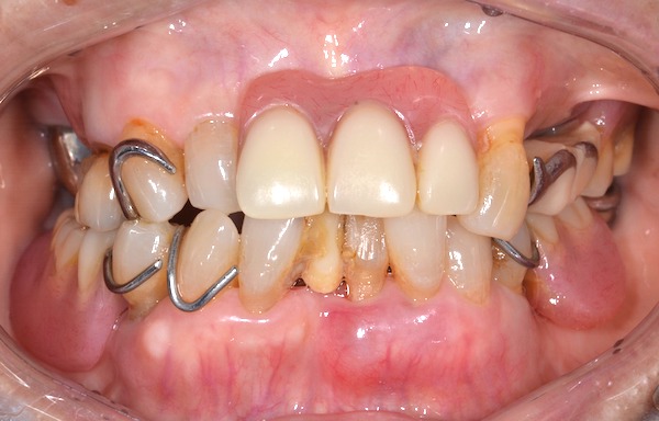 港南台パーク歯科クリニック｜ブログ症例｜歯周病で入れ歯になった患者様の噛み合わせ・見た目の回復｜治療前画像2