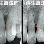 港南台パーク歯科クリニック|ブログ｜症例｜【症例】歯周病で溶けた骨を再生する治療（エムドゲイン・Bio-Oss）｜治療前後のレントゲン比較_画像1