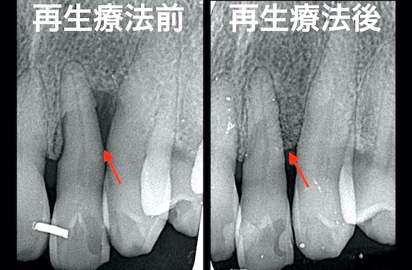 港南台パーク歯科クリニック|ブログ｜症例｜【症例】歯周病で溶けた骨を再生する治療（エムドゲイン・Bio-Oss）｜治療前後のレントゲン比較_画像1